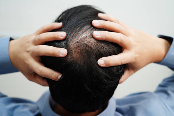 istock Bald head in man, hair loss treatment health problem. 2151268995
