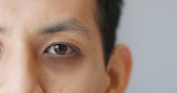 asian young man suffering from dark circles under his eyes