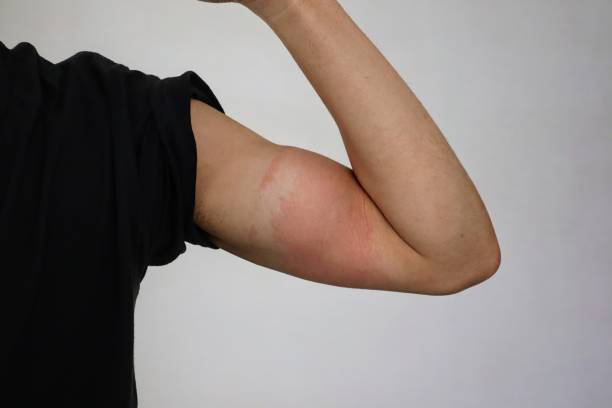 istock Japanese man's arm with rough skin 2151367557