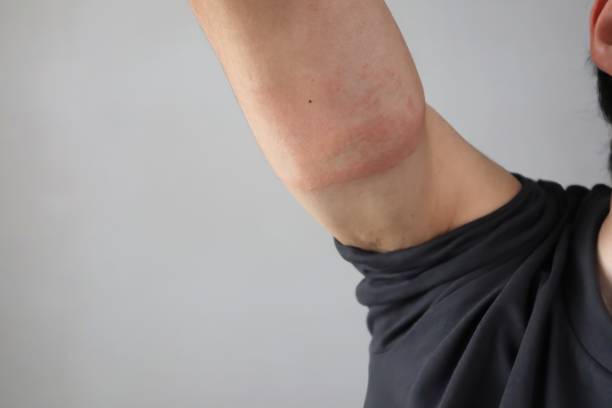 istock Japanese man's arm with rough skin 2151367617