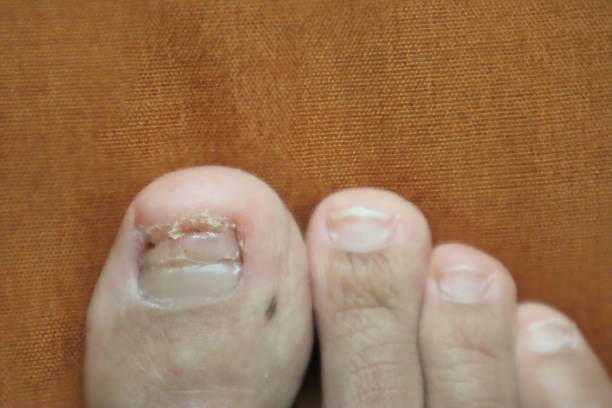istock An injured toenail that is still healing 2151367739