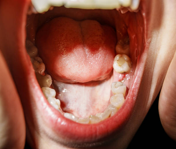 istock Woman after tooth extraction, medicine concept 2151530144