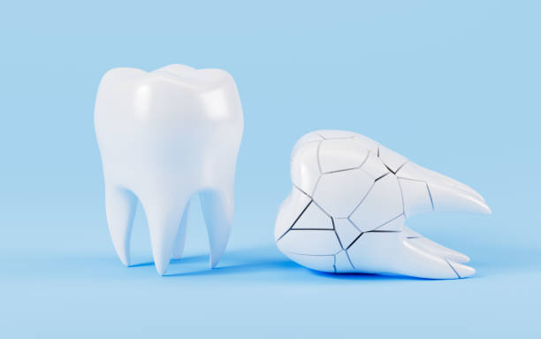 istock Human tooth model, tooth cracking, oral rehabilitation, 3d rendering. 2151638470