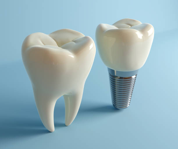 istock Tooth and implant dental abstract 3D illustration 2151695194