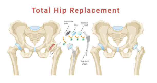 Total hip replacement surgery with anatomical acetabular prosthesis medical poster isometric vector Total hip replacement surgery with anatomical acetabular prosthesis medical poster isometric vector illustration. Medicine procedure with new artificial bone structure skeleton joint education scheme hip replacement stock illustrations