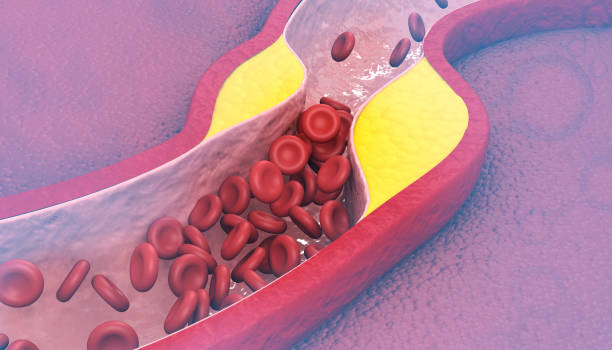 istock Bad cholesterol in blood 2151867025