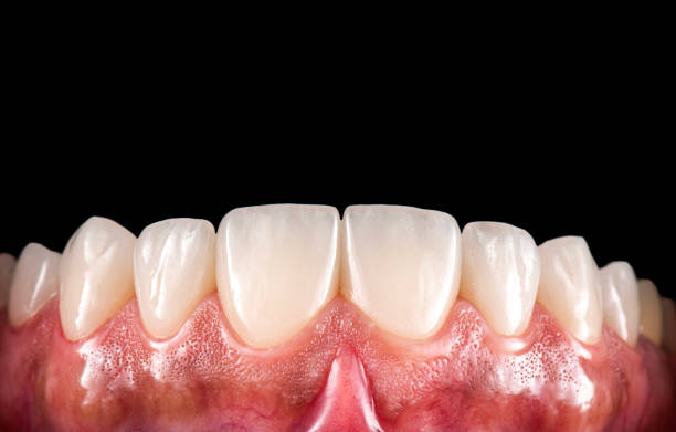 istock tooth restorations with emax ceramic crowns and veneers 2151928284