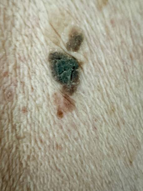 istock Verruca and melanoma on human back 2151989832
