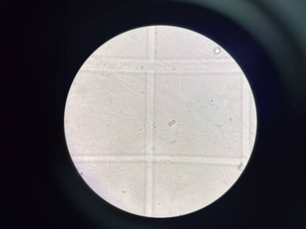 istock calcium oxalate crystal in urine. 2152005217