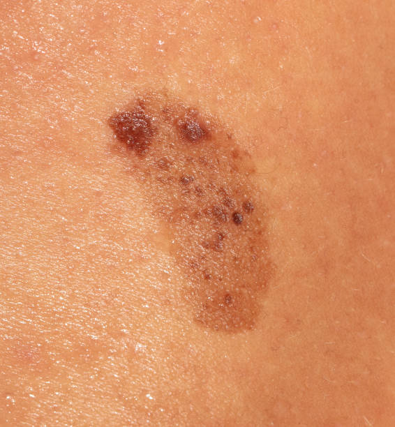 istock Birthmark on human skin. Macro 2152132654
