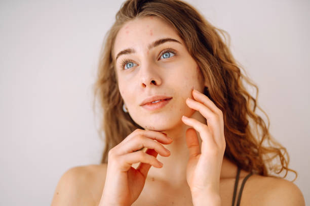 istock A young woman with bad skin. 2152235954