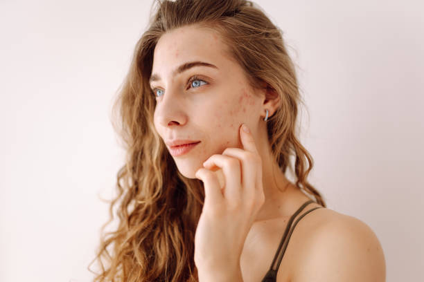 istock A young woman with bad skin. 2152235966