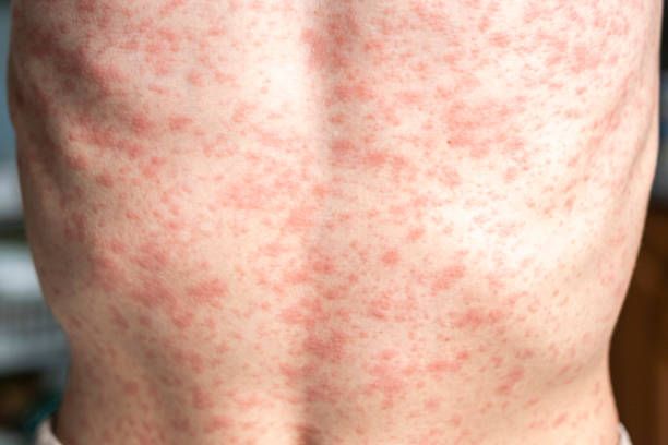 istock A person's body is covered in a rash, measles. 2152300012