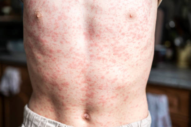 istock A person's body is covered in a rash, measles. 2152300023