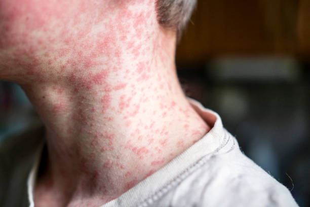 Measles viral disease, human skin covered with measles rash, vaccination concept Measles viral disease, human skin covered with measles rash, vaccination concept measles stock pictures, royalty-free photos & images