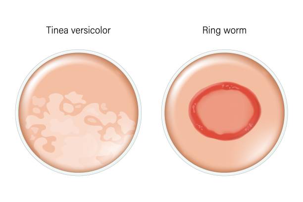 Comparison of Tinea versicolor and Ring worm. Dermatology. Dermatophytosis skin with fungal infection.