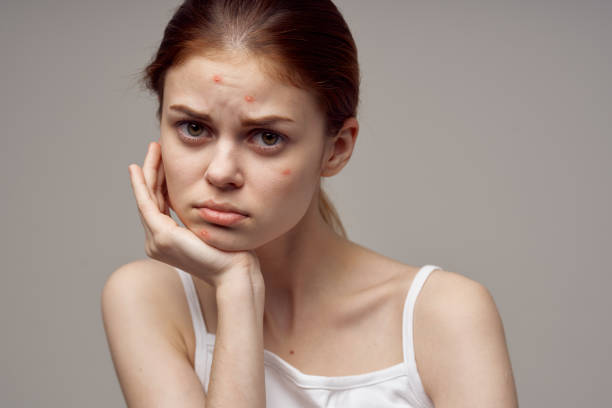 istock woman clean skin acne acne health problems dermatology 2152306003