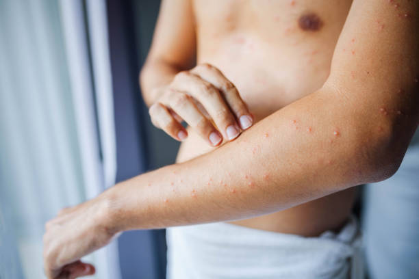 istock Man with red spots, skin disease. 2152402841