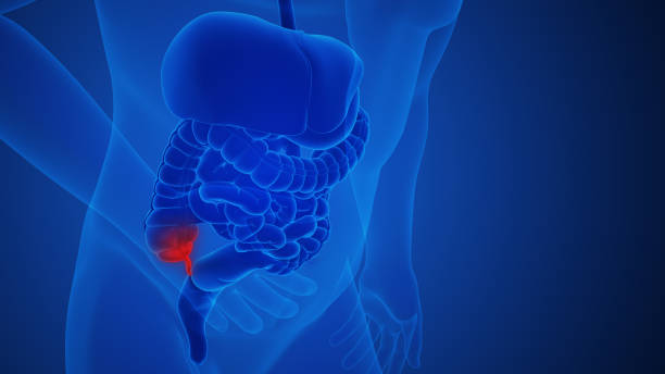 istock Appendix inflammation pain anatomy for medical concept 2152452419