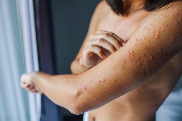 istock Man with red spots, skin disease. 2152555156