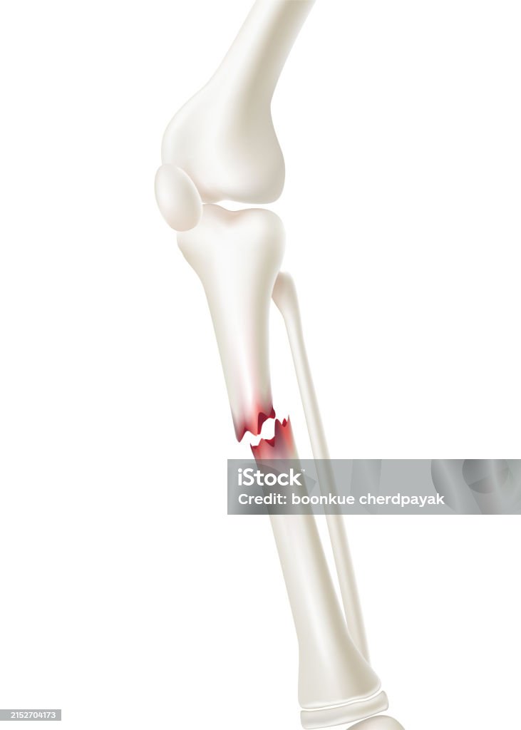 Tibia Up Close Broken Tibia Stock Illustration - Download Image Now - Accidents and ...