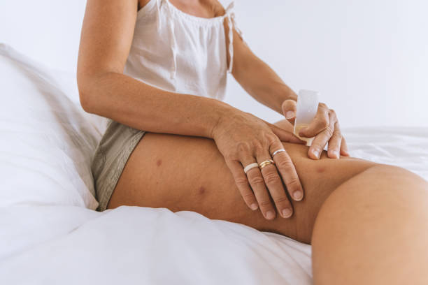Woman Treating Mosquito Bites with Anti-Itch Cream A close-up of a woman applying anti-itch cream to mosquito bites on her thigh to reduce inflammation and itching. hand thigh stock pictures, royalty-free photos & images