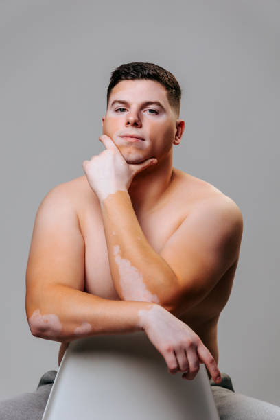istock A young man with vitiligo pigmentation loves himself, is not shy about his appearance. 2152900765