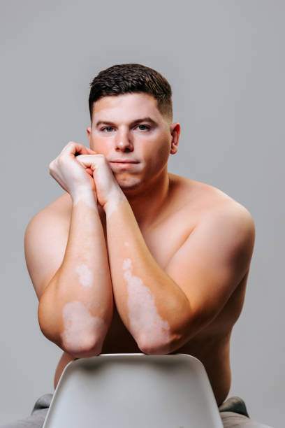 istock I am the same as everyone else and unique in its kind, a man with vitiligo sits on a chair. 2152900784