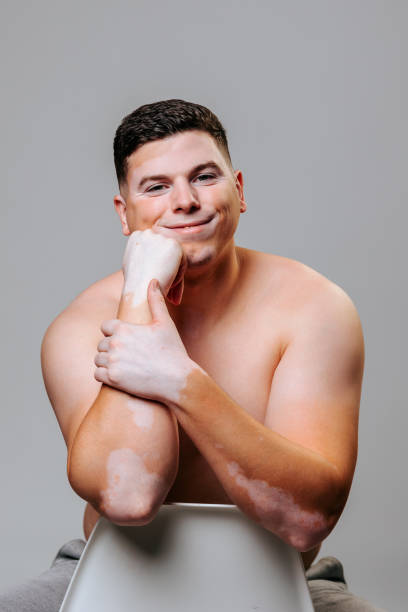 istock Young man skin blemishes visible white pigmentation create conceptual image of people with vitiligo. 2152901036
