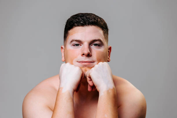 istock Front view young vitiligo man with naked torso in studio gray background propped chin with his hand. 2152901083