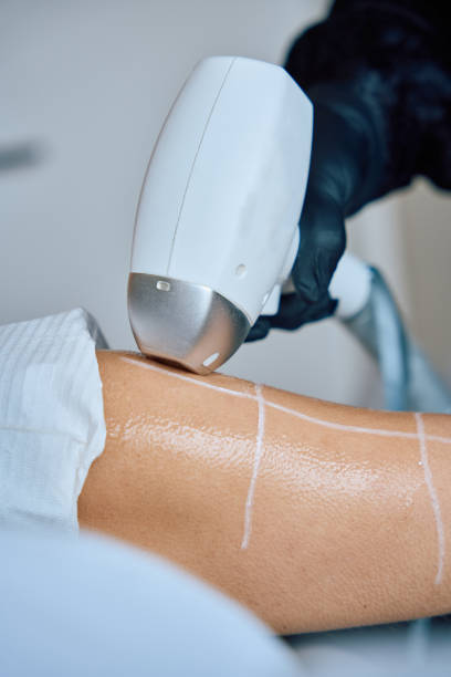 istock laser hair removal on arm 2153498599