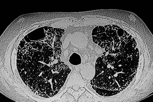 istock CAT Scan of patient  with tuberculosis infection 2153570350