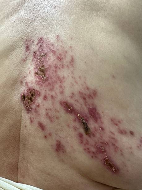 istock Shingles (herpes zoster) infection on human skin 2153587552