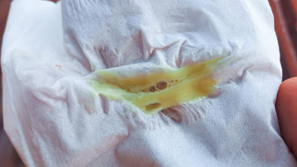 green snot on a piece of tissue. Green snot is most often caused by viral respiratory infections, especially rhinovirus. mocos verdes en un pedazo de pañuelo. los mocos verdes suelen ser causados por infecciones respiratorias virales, especialmente rinovirus. mucosidad como síntoma de la enfermedad. gripe y resfriado. enfermedades estacionales. mocos verdes.