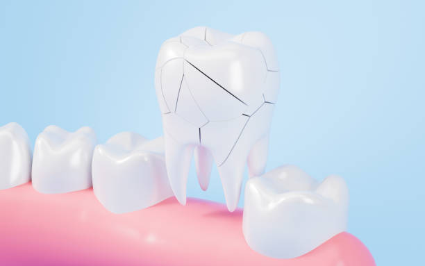 istock Human tooth model, tooth cracking, oral rehabilitation, 3d rendering. 2153756937