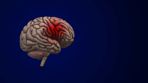 istock Brain bleed or an intracranial Hemorrhage 2153932716