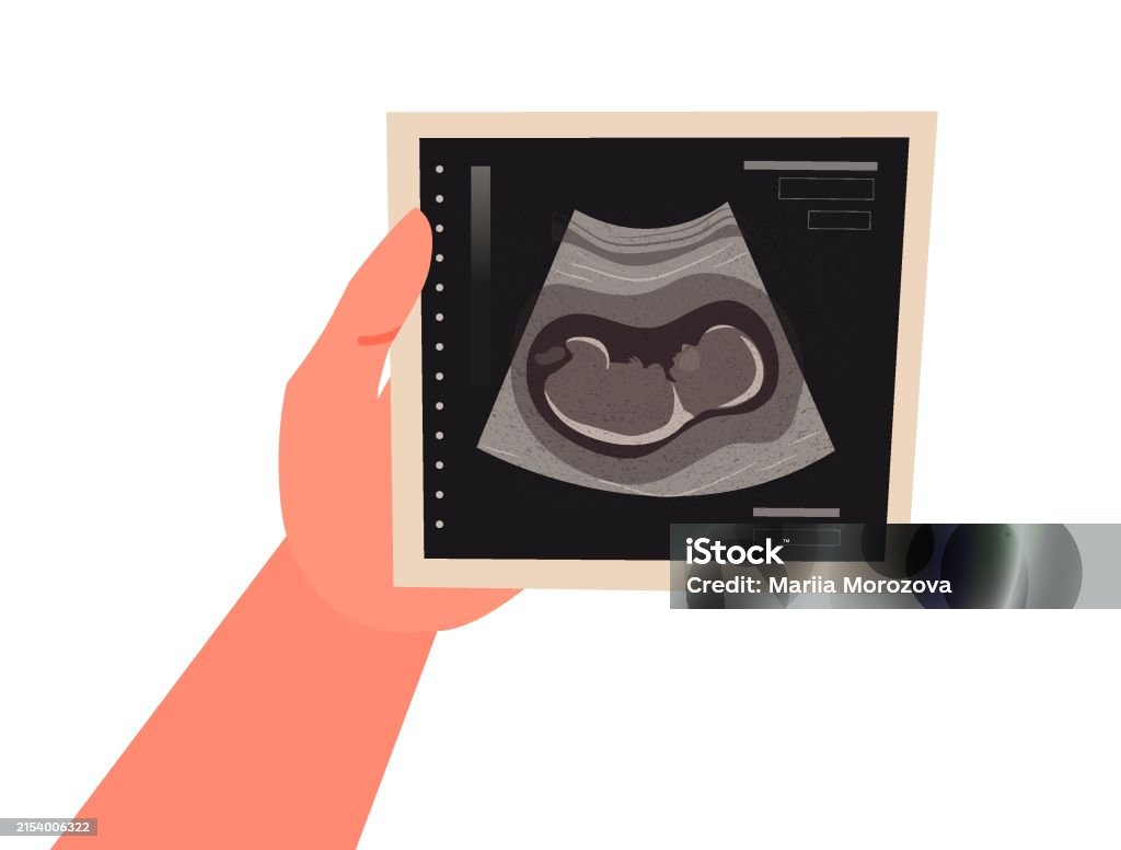 Ultrasound scan in hand. Baby ultrasound picture. Photo of ultrasound examination of infant. Cartoon vector illustration Pregnant stock vector Ultrasound scan in hand. Baby ultrasound picture. Photo of ultrasound examination of infant. Cartoon vector illustration Pregnant stock vector