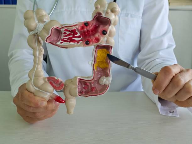 istock Doctor holding a scalpel on intestinal anatomy 2154015346