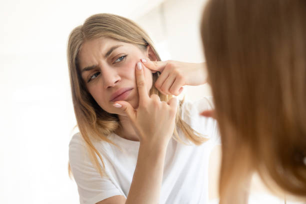 istock Stressed girl touching her skin and looking at mirror 2154108805