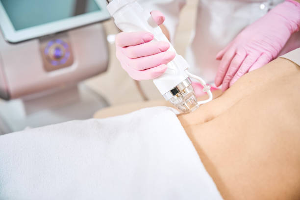 istock Cosmetologist conducting RF microneedling on female client body 2154175849