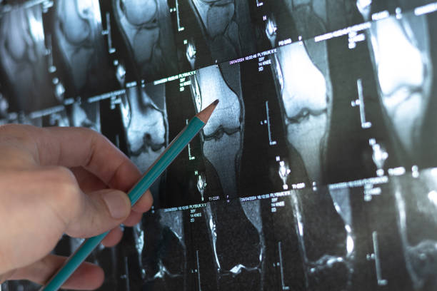 arzt untersucht knochenknietumor. röntgen und mrt, mrt, ct mit ausgeprägter sklerose um den nidus. medizinisches behandlungskonzept. diagnose der krankheit menschen knochen. - menschlicher knochen stock-fotos und bilder