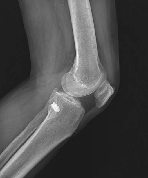 istock lateral Radiograph of the left knee 2154352925