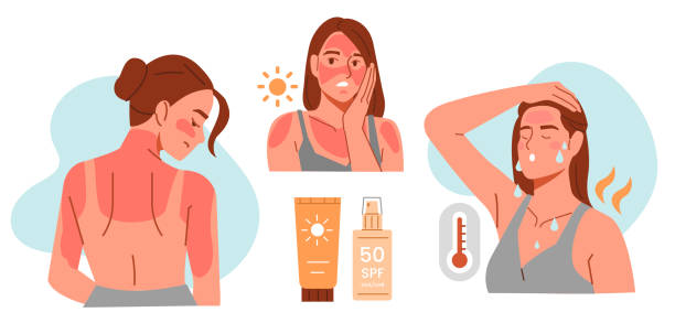 sunburn Woman has damaged from sunburn skin on her face and body and sunstroke by strong summer heat. Sun overexposure symptoms and UV protection concept. Vector illustration. sunburned stock illustrations