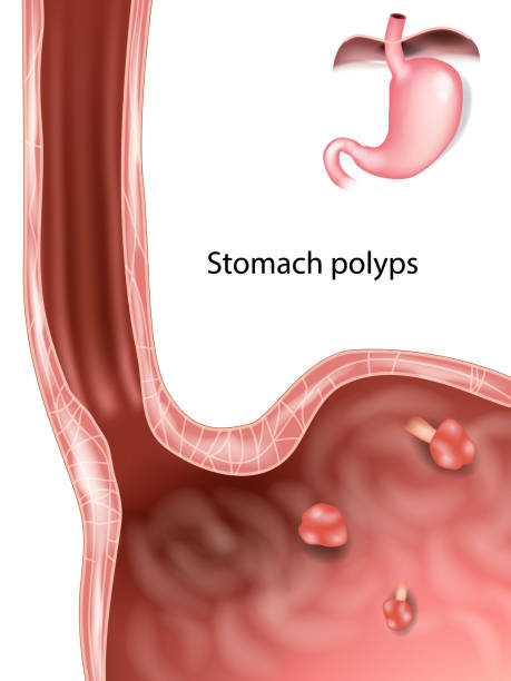 istock Polyps in Stomach. Gastric polyp. Medical illustration 2154425148