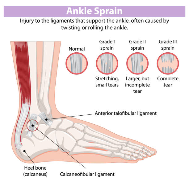 kuvapankkikuvitukset aiheesta detailed diagram of ankle sprain types - kantaluu
