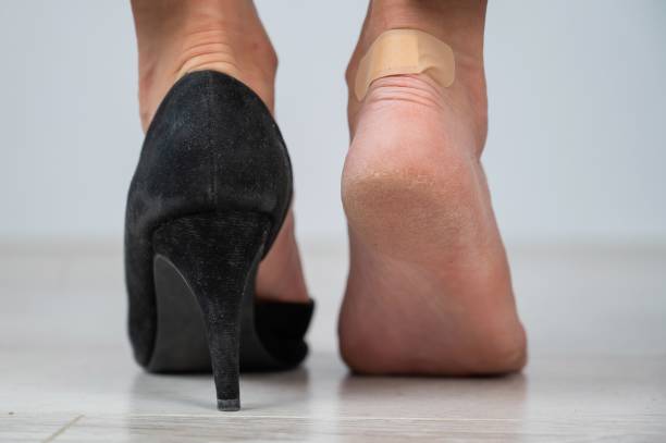 istock A woman in black shoes puts a plaster on a corn 2154612818