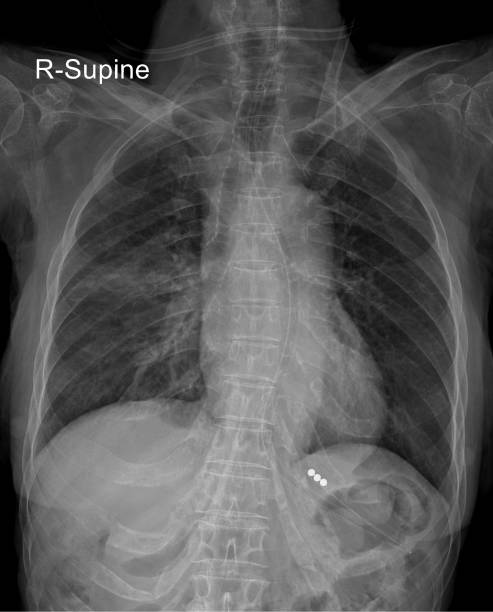 istock X-Ray Vision: Revealing Insights into Thoracic Anatomy and Pathology 2154700032