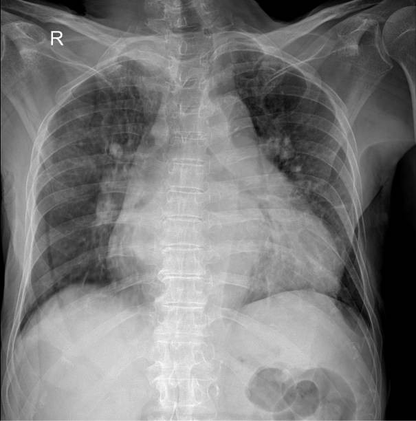 istock In-Depth Analysis of Chest X-Ray Patterns: A Clinical Perspective 2154700182