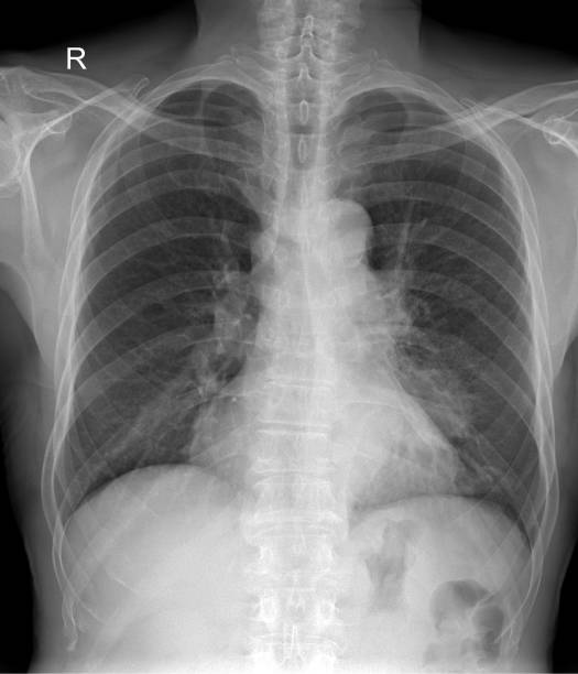istock Chest X-Ray Anatomy: A Detailed Examination of Thoracic Structures 2154700234