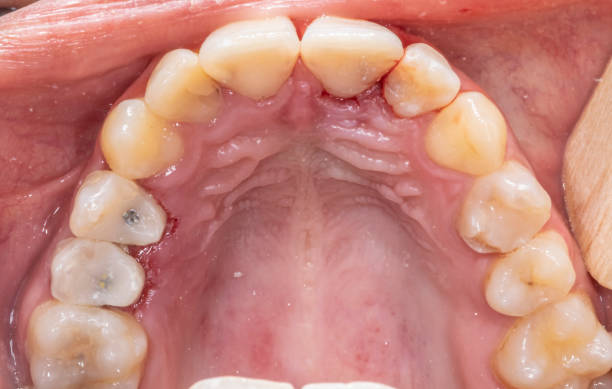 istock Occlusal view of a complete upper maxillary arch with restored teeth. 2154757668